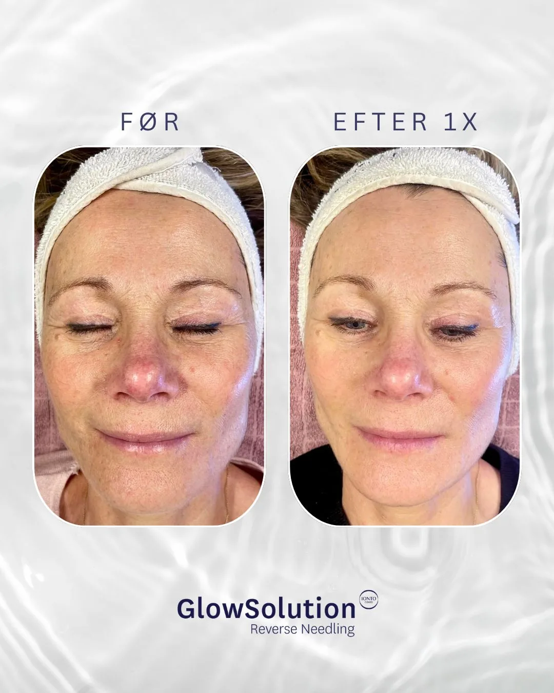 Før og efter én GlowSolution-behandling