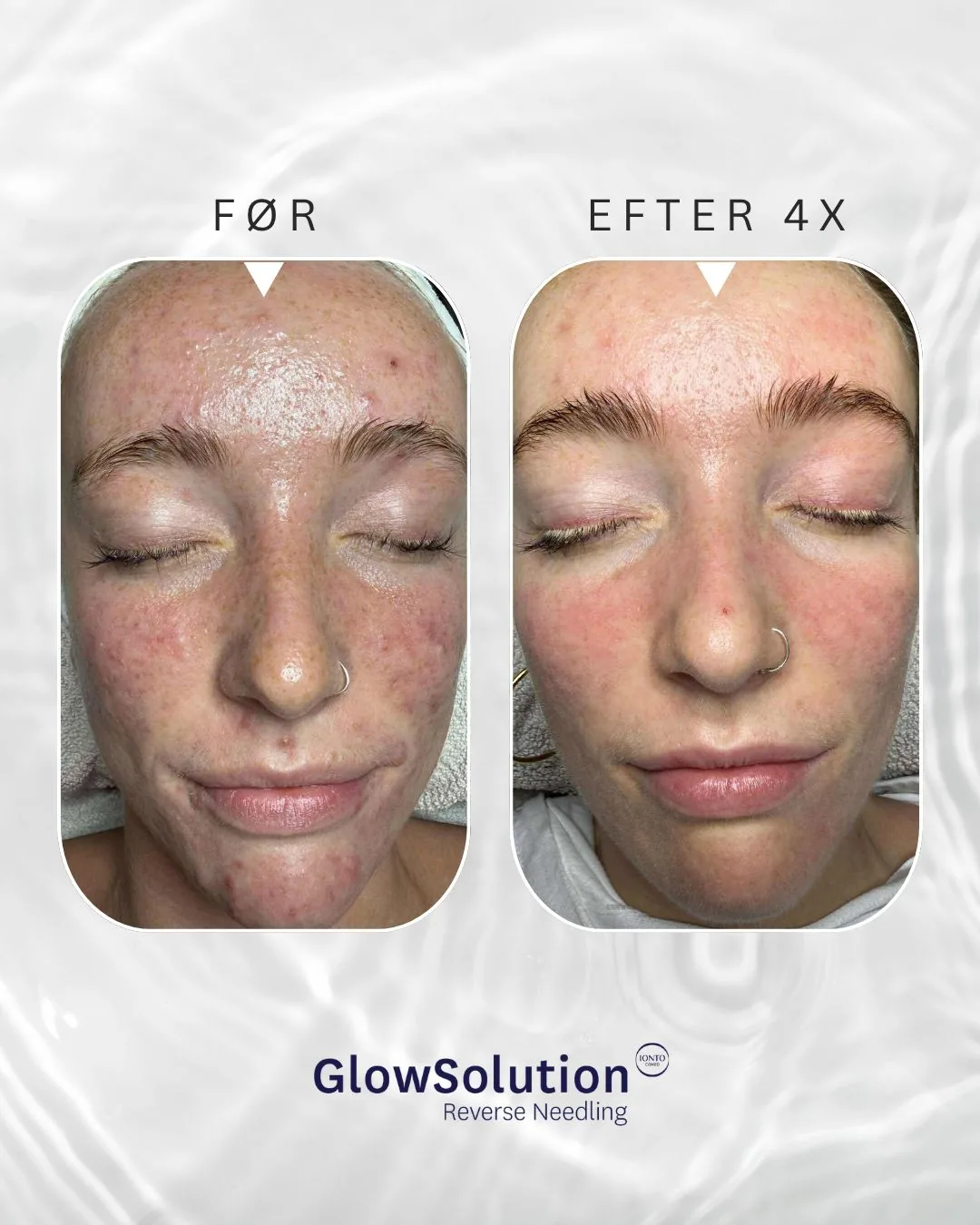 Før og efter fire GlowSolution-behandlinger
