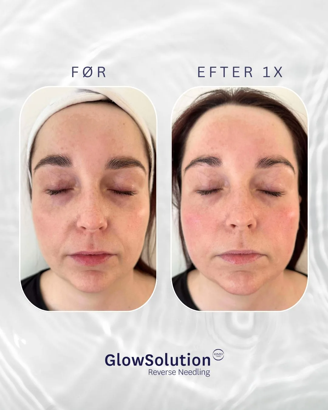 Før og efter én GlowSolution-behandling
