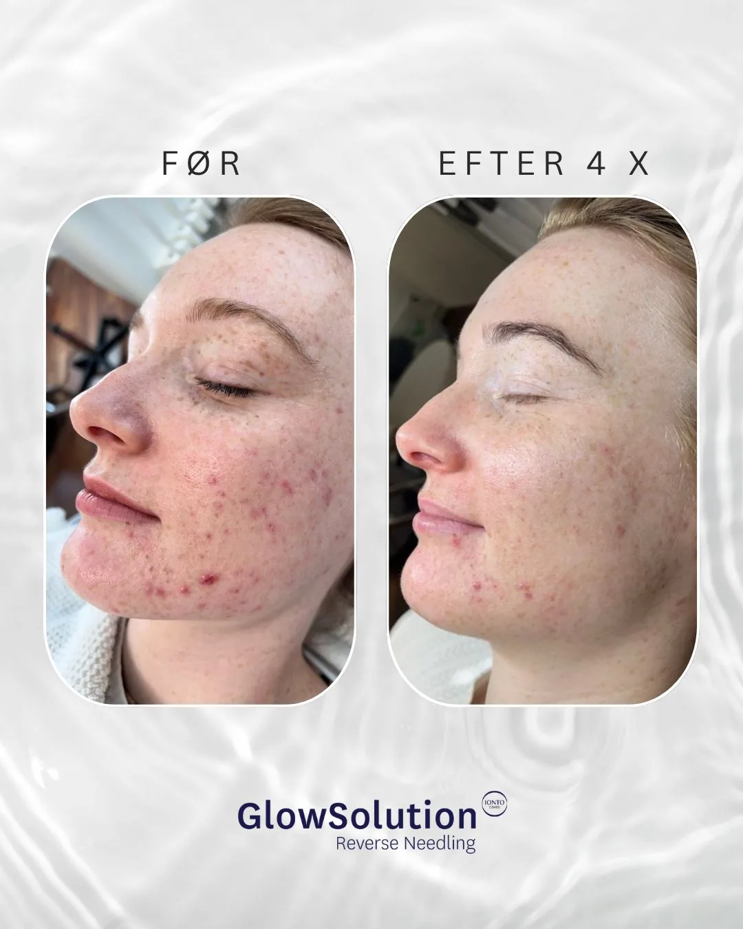 Før og efter fire GlowSolution-behandlinger
