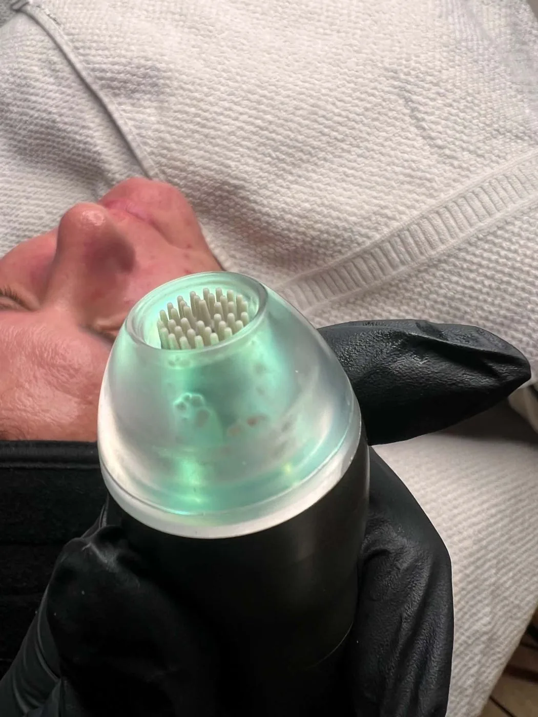 Reverse Needling på våd hud